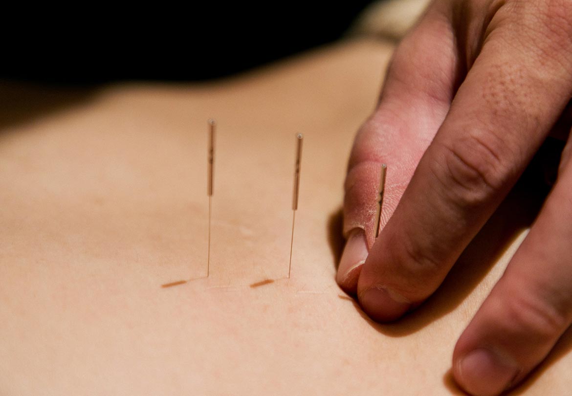 専門の鍼灸師がいるので鍼施術にも対応